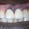 Crowns Before